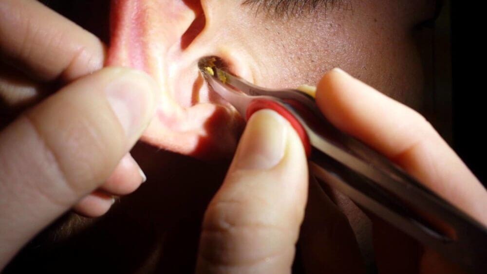 earwax-removal
