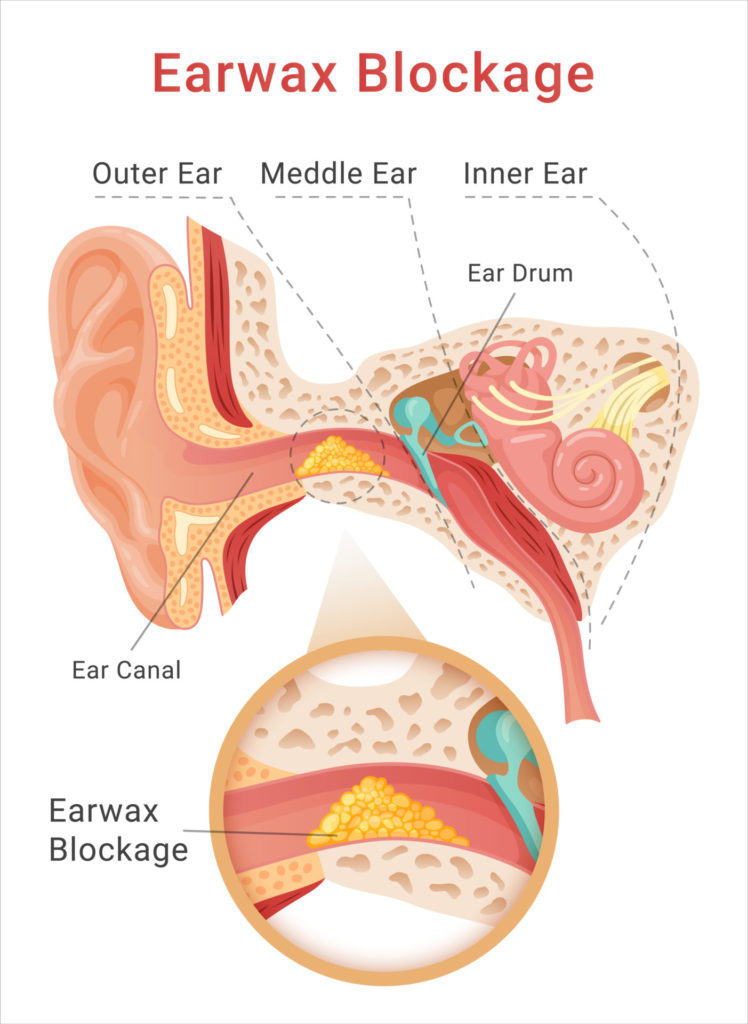 about ear wax